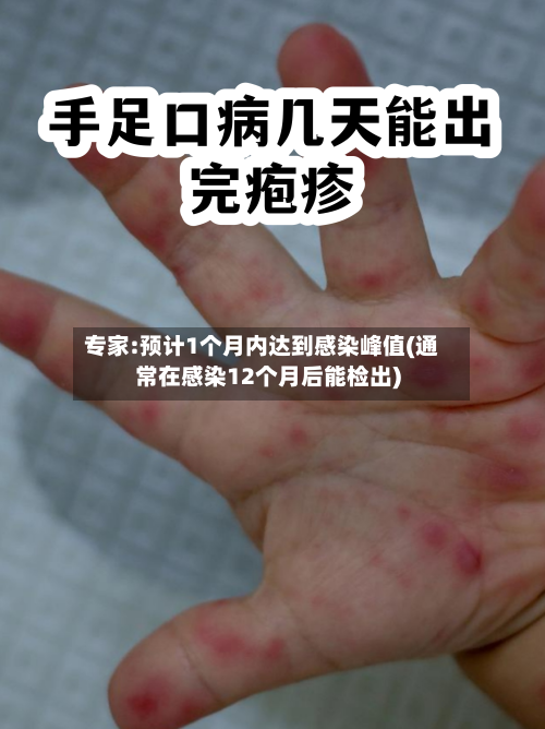 专家:预计1个月内达到感染峰值(通常在感染12个月后能检出)