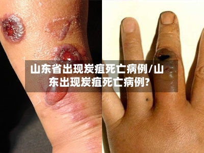 山东省出现炭疽死亡病例/山东出现炭疽死亡病例?