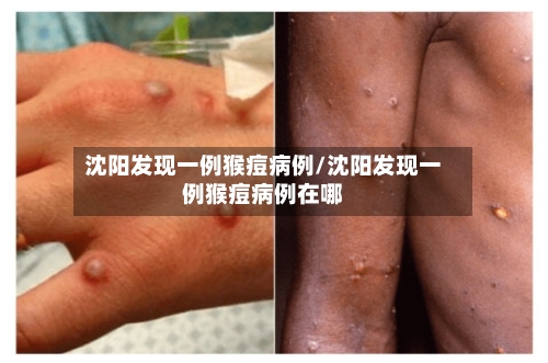 沈阳发现一例猴痘病例/沈阳发现一例猴痘病例在哪