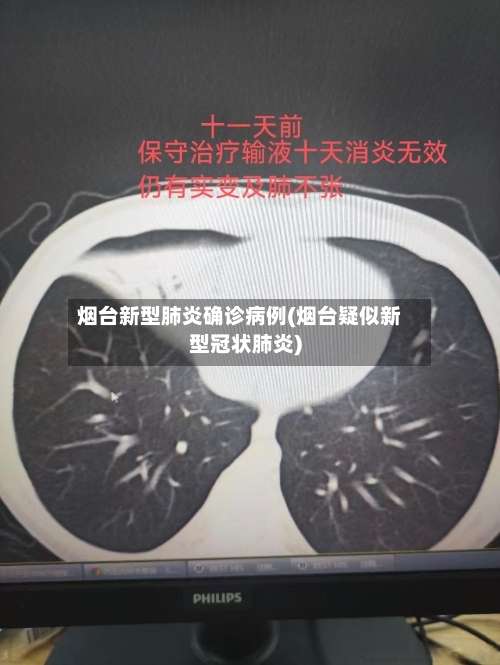 烟台新型肺炎确诊病例(烟台疑似新型冠状肺炎)