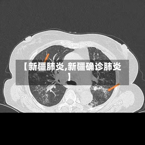 【新疆肺炎,新疆确诊肺炎】