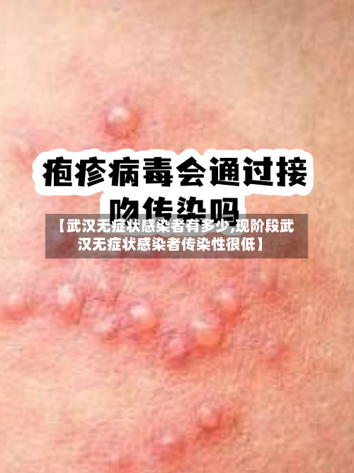 【武汉无症状感染者有多少,现阶段武汉无症状感染者传染性很低】-第2张图片